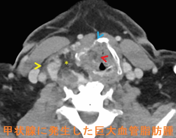 甲状腺に発生した巨大血管脂肪腫 CT画像 甲状腺に発生した巨大血管脂肪腫 CT画像