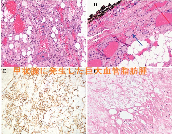 甲状腺に発生した巨大血管脂肪腫 組織像 甲状腺に発生した巨大血管脂肪腫 組織像