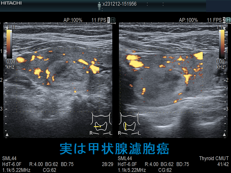 実は甲状腺濾胞癌 ドプラーモード 実は甲状腺濾胞癌 ドプラーモード