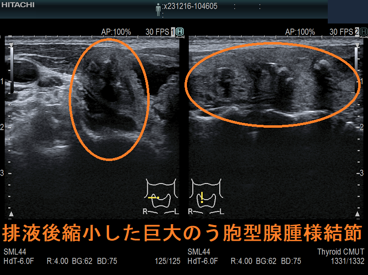排液後縮小した巨大のう胞型腺腫様結節 排液後縮小した巨大のう胞型腺腫様結節