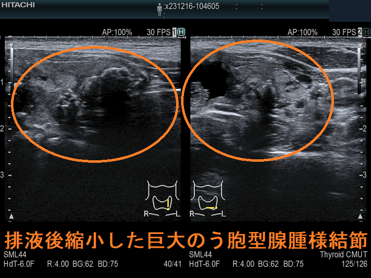排液後縮小した巨大のう胞型腺腫様結節2 排液後縮小した巨大のう胞型腺腫様結節2