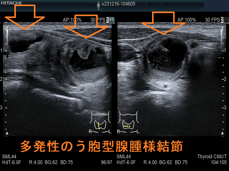 多発性のう胞型腺腫様結節 多発性のう胞型腺腫様結節
