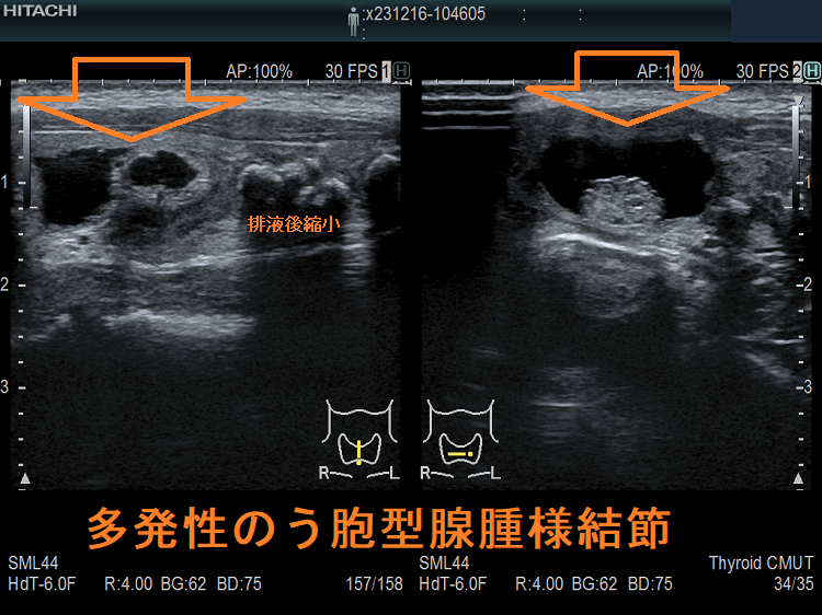 多発性のう胞型腺腫様結節2 多発性のう胞型腺腫様結節2