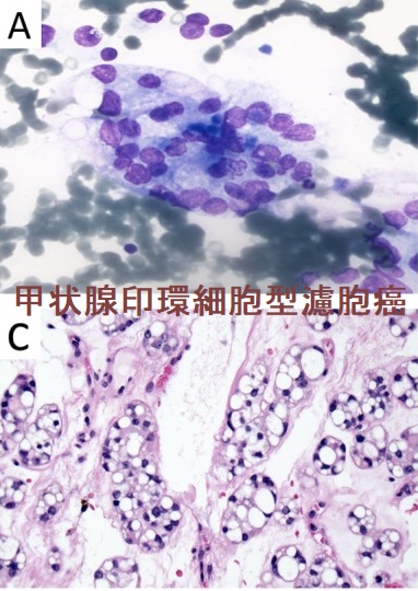 甲状腺印環細胞型濾胞癌 甲状腺印環細胞型濾胞癌