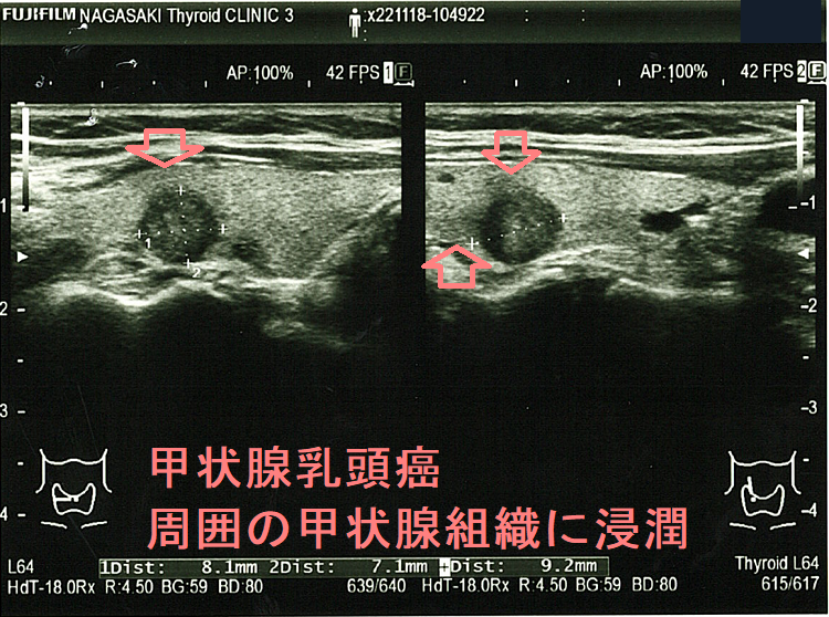 甲状腺乳頭癌 周囲の甲状腺組織に浸潤 甲状腺乳頭癌 周囲の甲状腺組織に浸潤