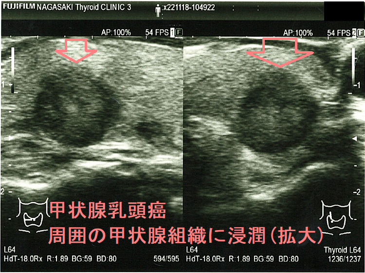 甲状腺乳頭癌 周囲の甲状腺組織に浸潤(拡大) 甲状腺乳頭癌 周囲の甲状腺組織に浸潤(拡大)