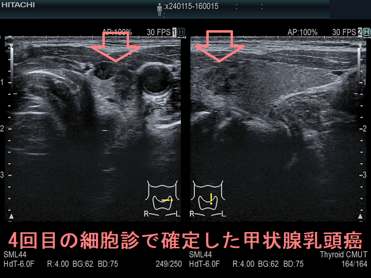 4回目の細胞診で確定した甲状腺乳頭癌 4回目の細胞診で確定した甲状腺乳頭癌