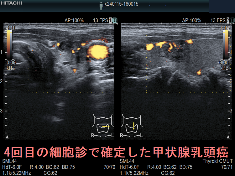 4回目の細胞診で確定した甲状腺乳頭癌 ドプラーモード 4回目の細胞診で確定した甲状腺乳頭癌 ドプラーモード