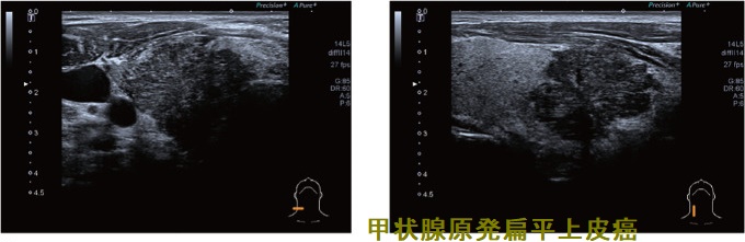 甲状腺原発扁平上皮癌 エコー3 甲状腺原発扁平上皮癌 エコー3