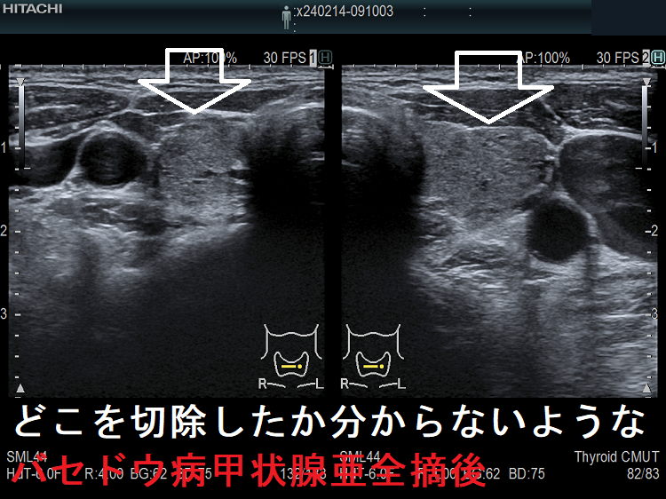 どこを切除したか分からないようなバセドウ病甲状腺亜全摘後 どこを切除したか分からないようなバセドウ病甲状腺亜全摘後