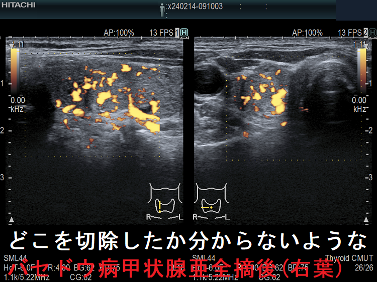 どこを切除したか分からないようなバセドウ病甲状腺亜全摘後(右葉)ドプラーモード どこを切除したか分からないようなバセドウ病甲状腺亜全摘後(右葉)ドプラーモード