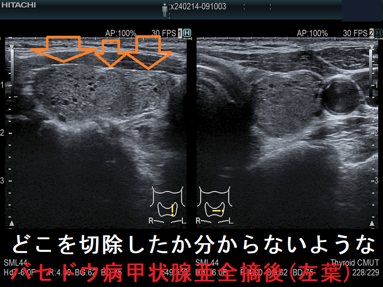 どこを切除したか分からないようなバセドウ病甲状腺亜全摘後(左葉) どこを切除したか分からないようなバセドウ病甲状腺亜全摘後(左葉)