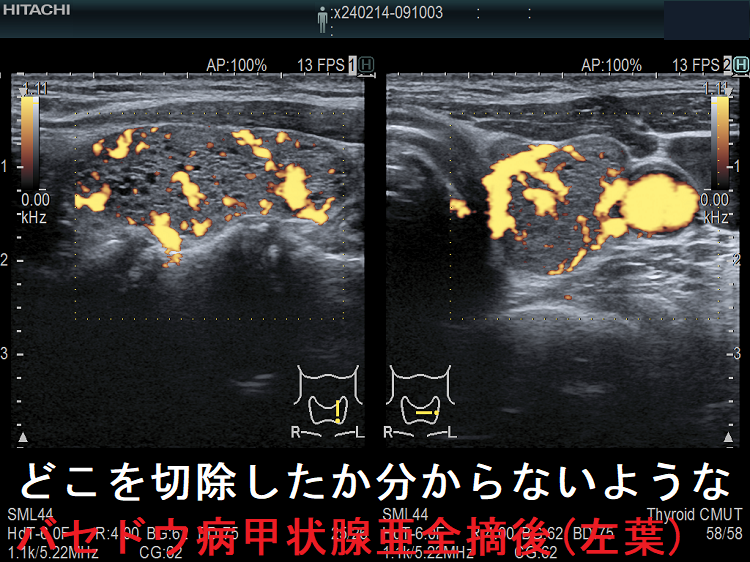 どこを切除したか分からないようなバセドウ病甲状腺亜全摘後(左葉)ドプラーモード どこを切除したか分からないようなバセドウ病甲状腺亜全摘後(左葉)ドプラーモード