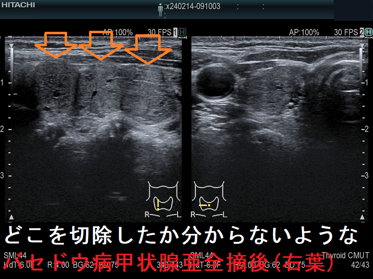 どこを切除したか分からないようなバセドウ病甲状腺亜全摘後(右葉) どこを切除したか分からないようなバセドウ病甲状腺亜全摘後(右葉)