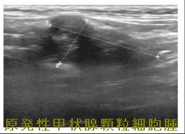 原発性甲状腺顆粒細胞腫 超音波検査(エコー)画像 原発性甲状腺顆粒細胞腫 超音波検査(エコー)画像