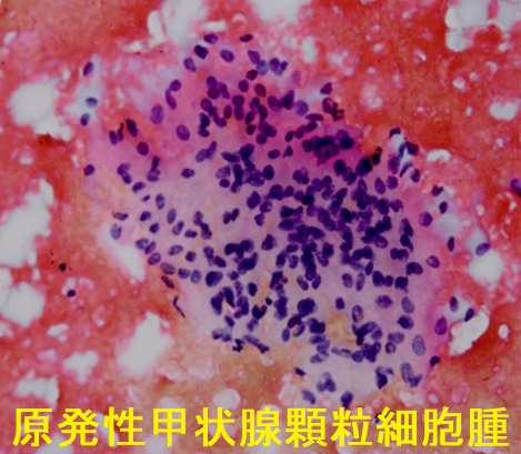 甲状腺顆粒細胞腫 細胞診 甲状腺顆粒細胞腫 細胞診