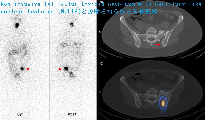 Non-invasive follicular thyroid neoplasm with papillary-like nuclear features (NIFTP)と診断されながらも骨転移 Non-invasive follicular thyroid neoplasm with papillary-like nuclear features (NIFTP)と診断されながらも骨転移