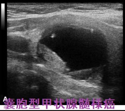 嚢胞型甲状腺髄様癌 エコー画像 嚢胞型甲状腺髄様癌 エコー画像