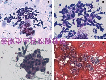 嚢胞型甲状腺髄様癌 細胞診 嚢胞型甲状腺髄様癌 細胞診