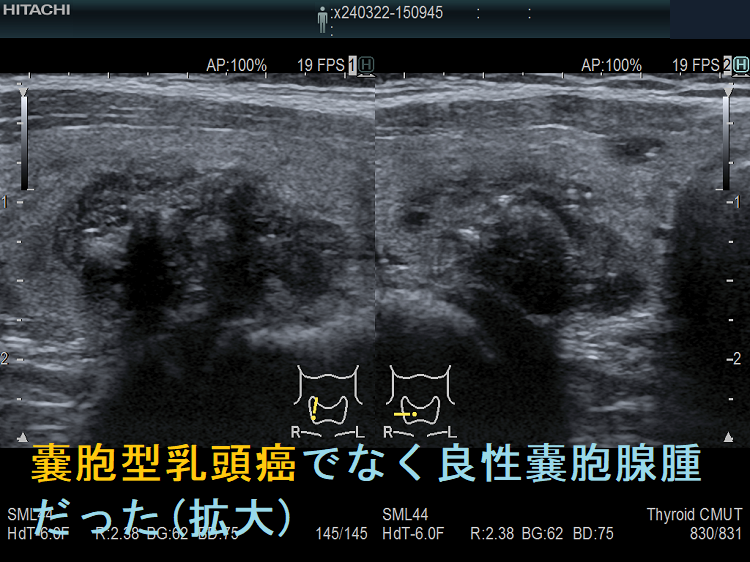 のう胞型甲状腺乳頭癌(のう胞内甲状腺乳頭癌:嚢胞型乳頭癌)でなく良性嚢胞腺腫だった (拡大) のう胞型甲状腺乳頭癌(のう胞内甲状腺乳頭癌:嚢胞型乳頭癌)でなく良性嚢胞腺腫だった (拡大)