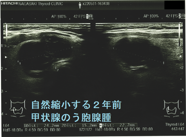 自然縮小する2年前 甲状腺のう胞腺腫 自然縮小する2年前 甲状腺のう胞腺腫