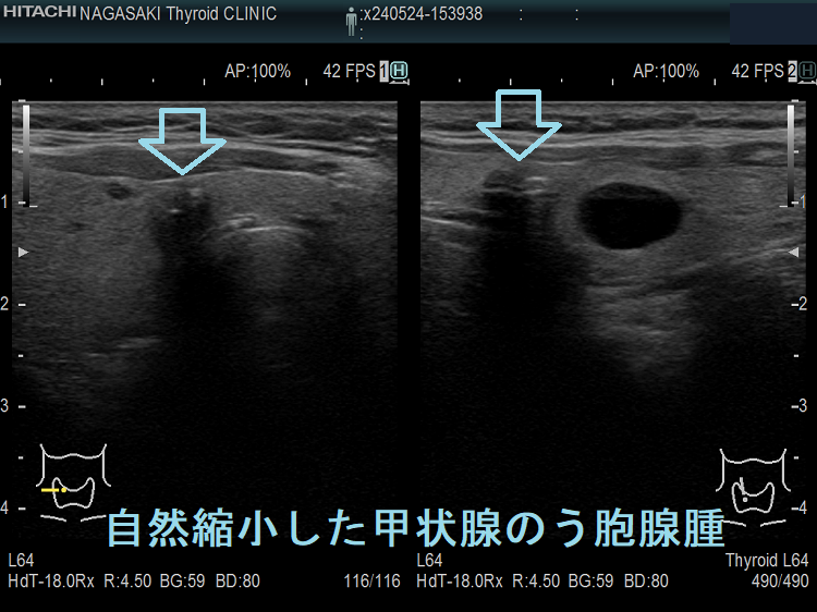 自然縮小した甲状腺のう胞腺腫 自然縮小した甲状腺のう胞腺腫