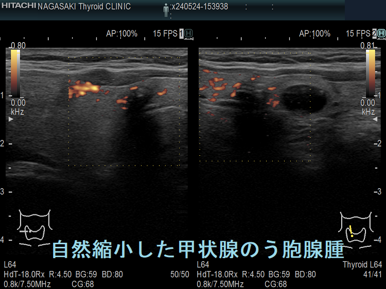 自然縮小した甲状腺のう胞腺腫 ドプラーモード 自然縮小した甲状腺のう胞腺腫 ドプラーモード