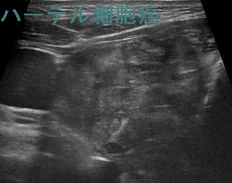 ハースル細胞癌 超音波(エコー)画像 ハースル細胞癌 超音波(エコー)画像