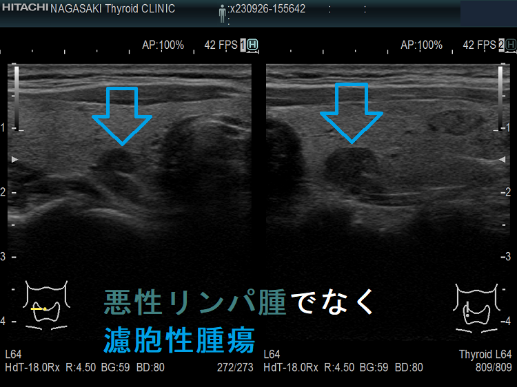 甲状腺悪性リンパ腫でなく濾胞性腫瘍 超音波(エコー)画像 甲状腺悪性リンパ腫でなく濾胞性腫瘍 超音波(エコー)画像