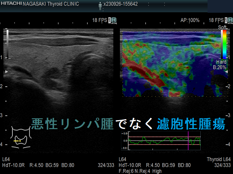 甲状腺悪性リンパ腫でなく濾胞性腫瘍 超音波(エコー)画像(エラストグラフィー) 甲状腺悪性リンパ腫でなく濾胞性腫瘍 超音波(エコー)画像(エラストグラフィー)