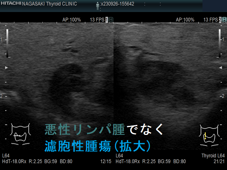 甲状腺悪性リンパ腫でなく濾胞性腫瘍 超音波(エコー)画像 (拡大) 甲状腺悪性リンパ腫でなく濾胞性腫瘍 超音波(エコー)画像 (拡大)