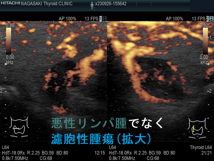 甲状腺悪性リンパ腫でなく濾胞性腫瘍 超音波(エコー)画像 (拡大)ドプラーモード 甲状腺悪性リンパ腫でなく濾胞性腫瘍 超音波(エコー)画像 (拡大)ドプラーモード