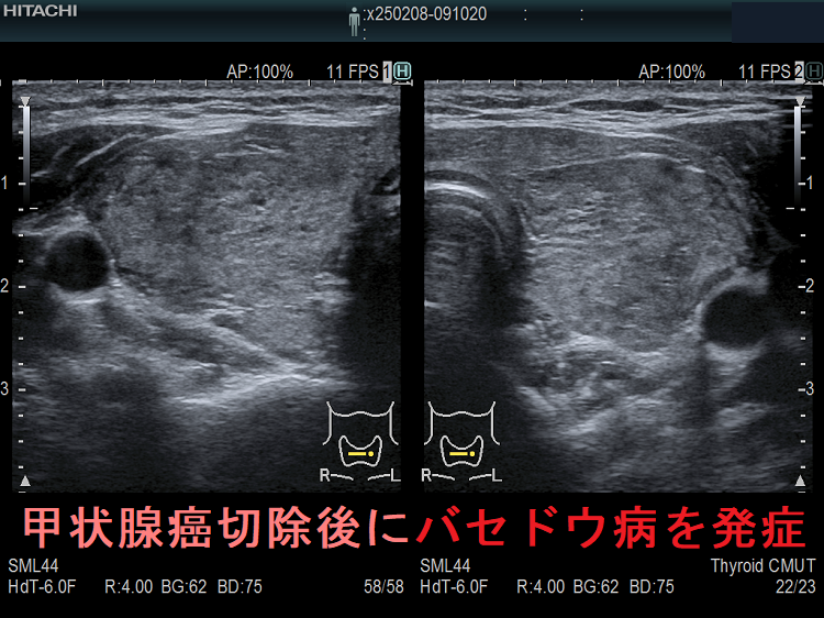 甲状腺癌切除手術のストレスで発症したバセドウ病 甲状腺癌切除手術のストレスで発症したバセドウ病