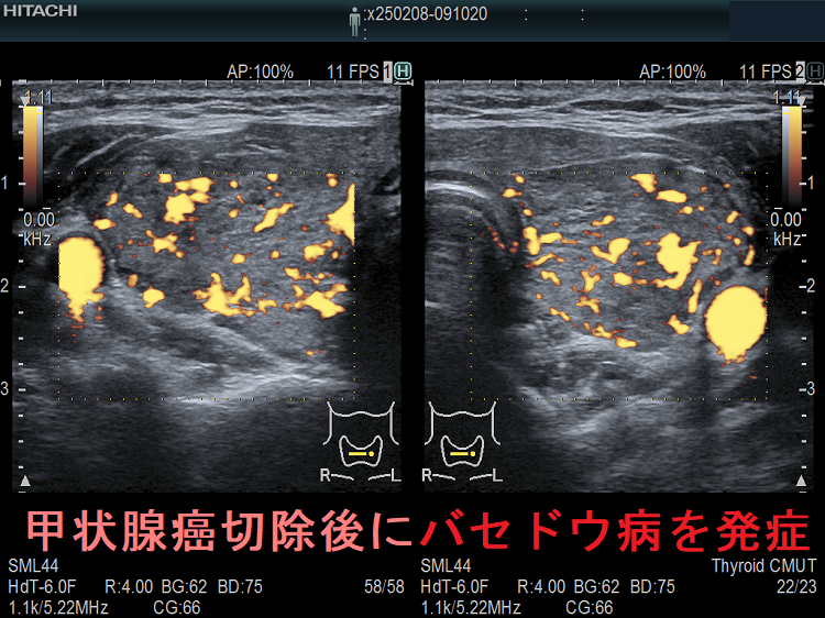 甲状腺癌切除手術のストレスで発症したバセドウ病 ドプラーモード 甲状腺癌切除手術のストレスで発症したバセドウ病 ドプラーモード