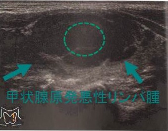 甲悪性リンパ腫の穿刺細胞診 甲悪性リンパ腫の穿刺細胞診