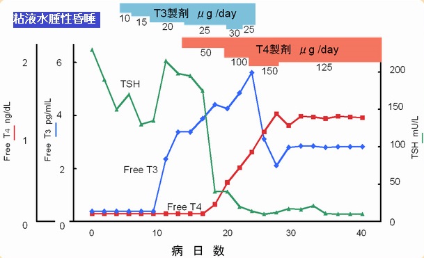 粘液水腫性昏睡 経過 粘液水腫性昏睡 経過