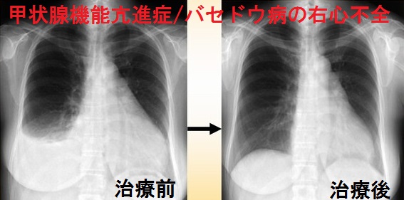 甲状腺機能亢進症/バセドウ病の右心不全 甲状腺機能亢進症/バセドウ病の右心不全