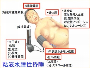 粘液水腫性昏睡の症状 粘液水腫性昏睡の症状