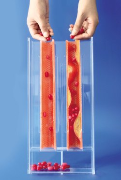 プラークの動脈硬化模型 プラークの動脈硬化模型