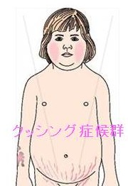 クッシング症候群の肥満 クッシング症候群の肥満