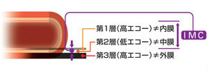 総頚動脈内膜中膜肥厚度(CCA IMT) 総頚動脈内膜中膜肥厚度(CCA IMT)