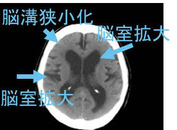 正常圧水頭症(iNPH) 正常圧水頭症(iNPH)