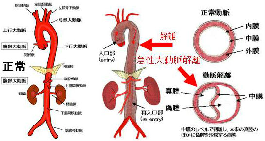 急性大動脈解離 急性大動脈解離