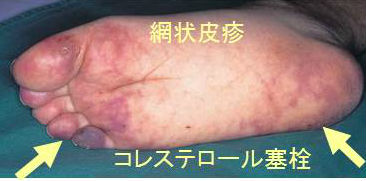 コレステロール塞栓症 網状皮斑(リベドー) コレステロール塞栓症 網状皮斑(リベドー)
