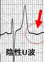 心電図胸部誘導の陰性U波 心電図胸部誘導の陰性U波