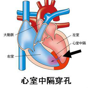 心室中隔穿孔 心室中隔穿孔