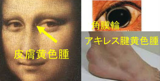 家族性高コレステロール血症 家族性高コレステロール血症