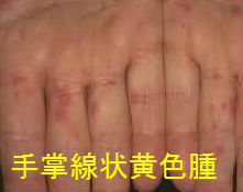 家族性Ⅲ型高脂血症 手掌線状黄色腫 家族性Ⅲ型高脂血症 手掌線状黄色腫