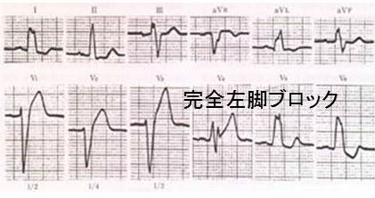完全左脚ブロック 完全左脚ブロック