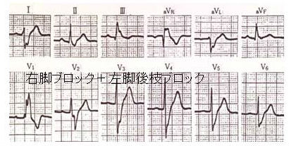 右脚ブロック+左脚後枝ブロック(二束ブロック) 右脚ブロック+左脚後枝ブロック(二束ブロック)